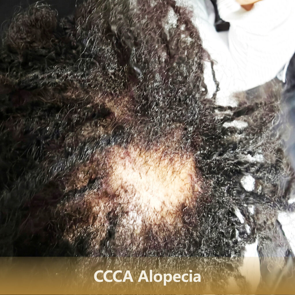 1 CCCA Alopecia 1 1024x1024
