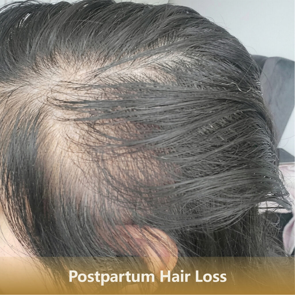 3 产后Postpartum Hair Loss 1 1024x1024