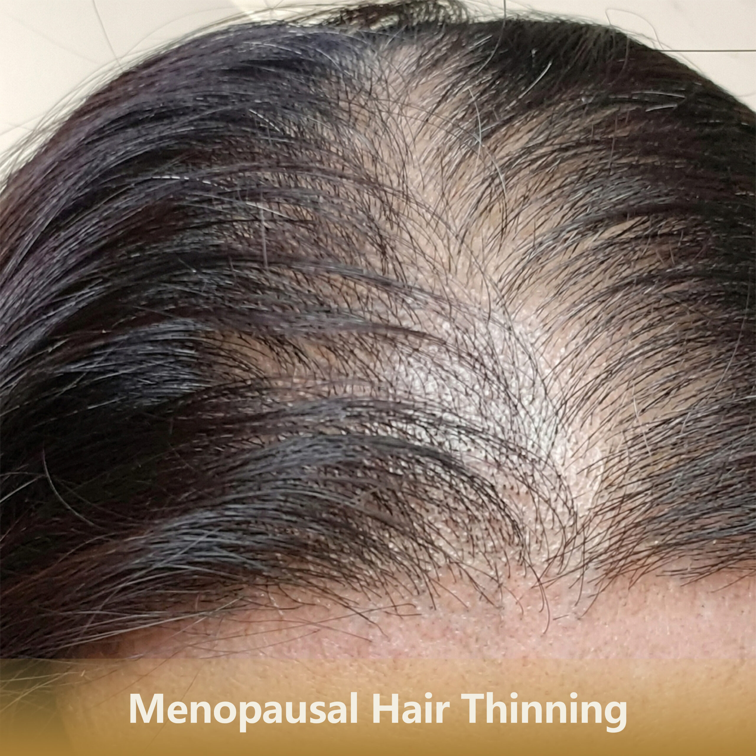 5 更年期脱发Menopausal Hair Thinning 1 Scaled